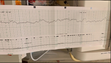 分娩監視装置の画像